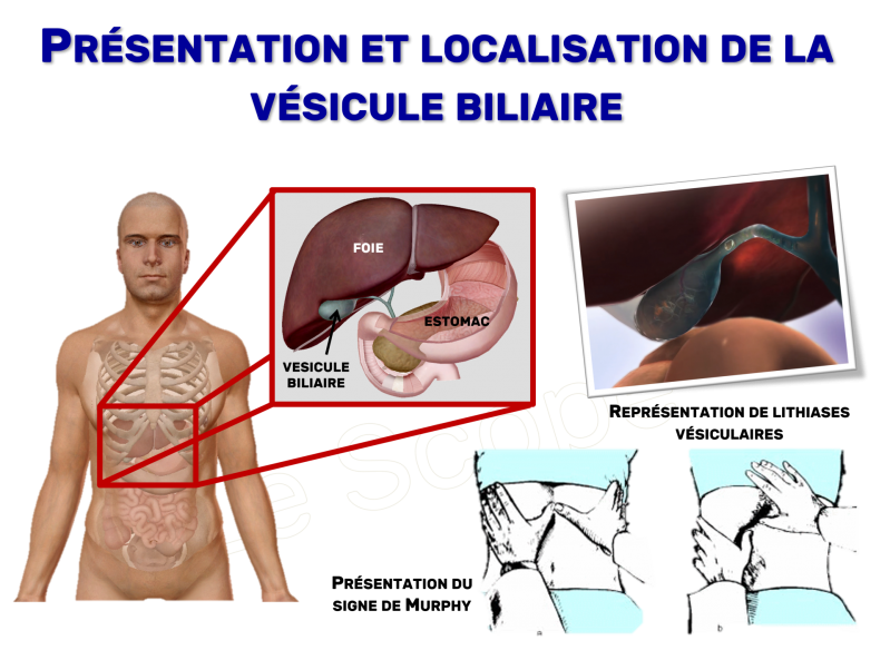 Signe Murphy Le Scope : Il existe un signe clinique appelé Signe de Murphy