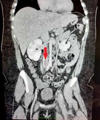 Coupe frontale thrombus