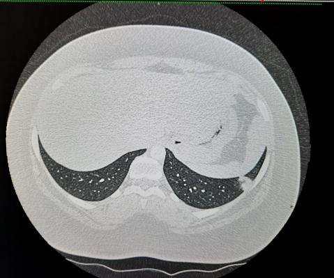 Coupe transversale infarctus pulmonaire