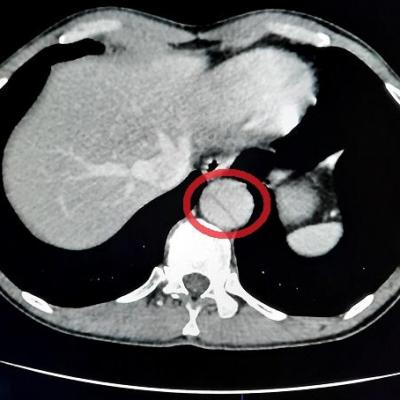 Dissection aortique transversal