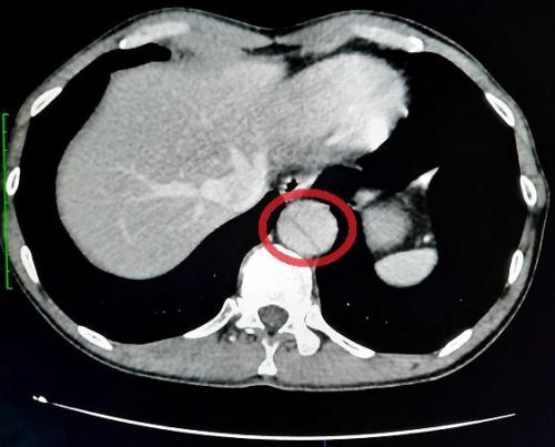 Dissection aortique transversal