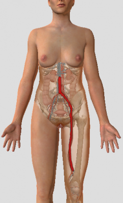 Modelisation du thrombus partiel